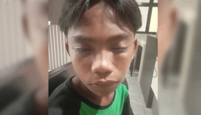 Siswa SMP 3 Duhiadaa Pohuwato Alami Luka Akibat Aksi Bullying